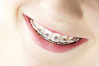 Braces in Owensboro