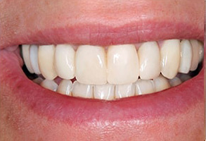 Owensboro Before and After Dental Crowns