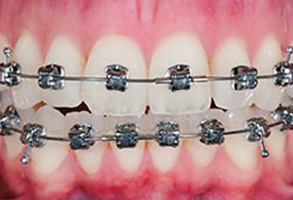 Owensboro Before and After Dental Crowns