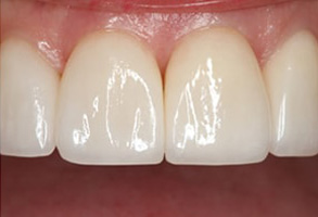 Owensboro Before and After Dental Crowns