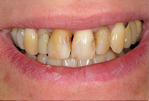 Owensboro Before and After Teeth Whitening