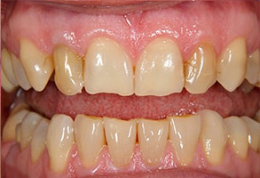 42301 Before and After Veneers
