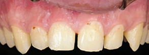 42301 Before and After Veneers