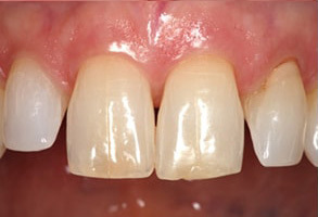 Owensboro Before and After Teeth Whitening