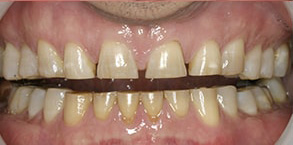 42301 Before and After Veneers